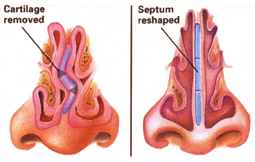 septoplasty septum nasal deviated surgery nose turbinates sleep apnea turbinate does normal structure procedure snoring parts breathing sinus inside narrow